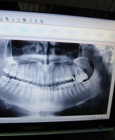 PANTOMOGRAPHIC X-RAY